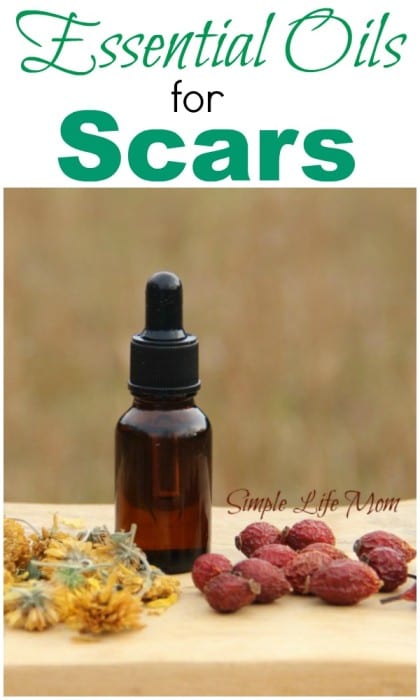 essential oils for scars - natural, organic, method for speeding the healing process