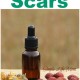 Essential Oils for Scars
