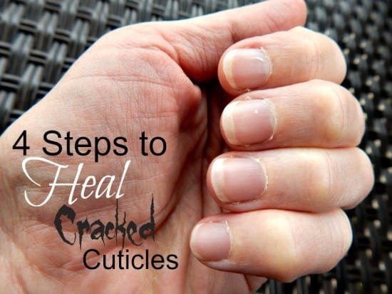 finger how bleeding stop 4 Cuticles Heal Life Cracked to Mom  Simple Steps