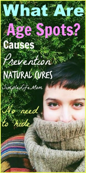 What Are Age Spots - causes, prevention, and natural cures
