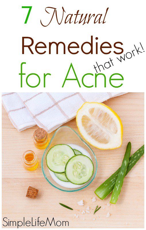 7 Natural Remedies for Acne that work from Simple Life Mom